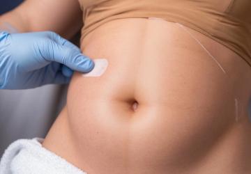 Body Remodeling 4.0: почему VASER-липосакция — это уже не просто удаление жира