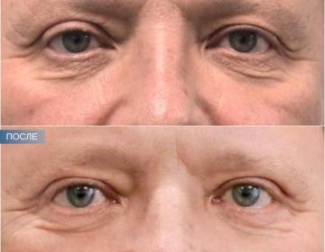 Блефаропластика