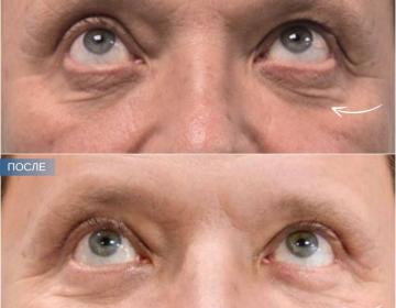 Блефаропластика