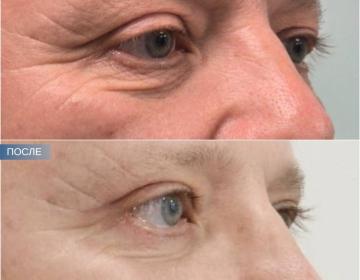 Блефаропластика