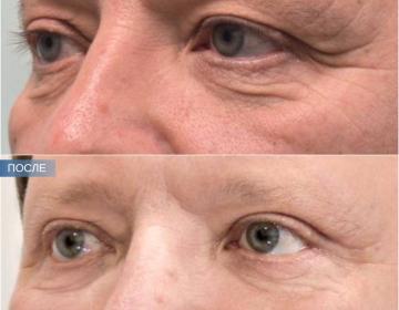 Блефаропластика