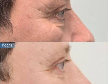 Блефаропластика