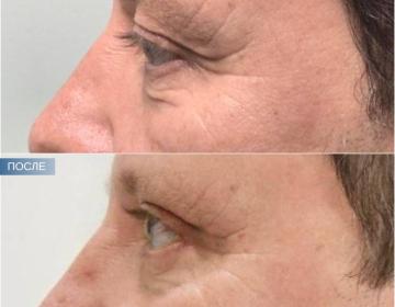 Блефаропластика