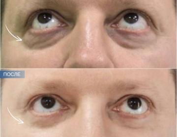 Блефаропластика