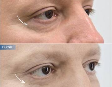 Пластика век