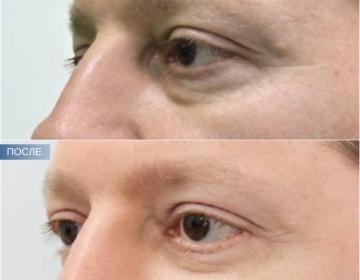 Блефаропластика