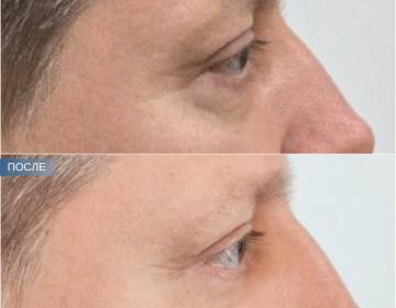 Пластика век