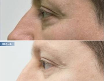 Блефаропластика