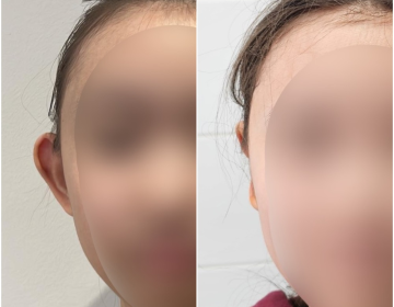 Пластика ушей