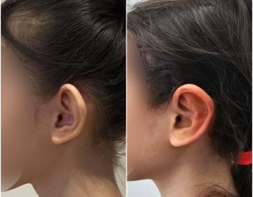 Пластика ушей