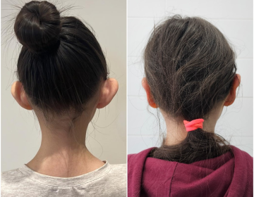 Отопластика