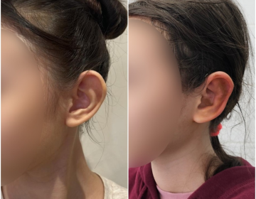  пластика ушей