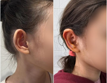 Отопластика