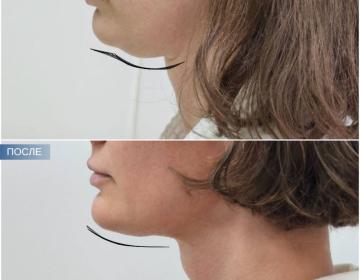 Пластика шеи и подбородка