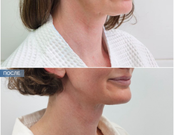 Пластика шеи и подбородка