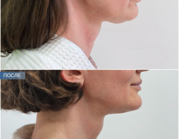 Пластика шеи и подбородка