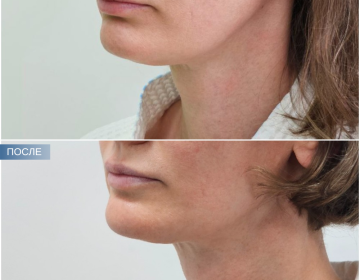 Пластика шеи и подбородка