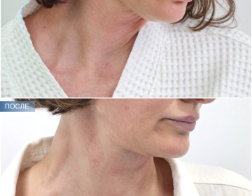 Пластика шеи и подбородка