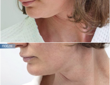 Пластика шеи и подбородка
