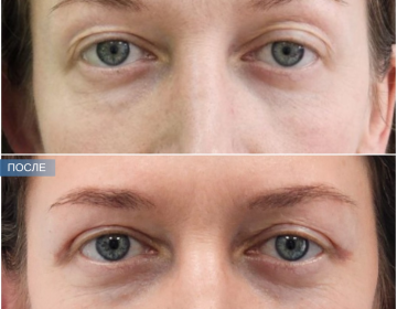 Пластика век