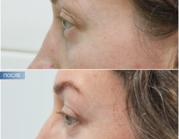 Пластика век