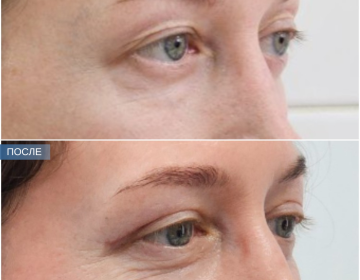 Блефаропластика