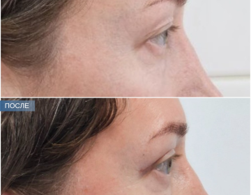 Блефаропластика