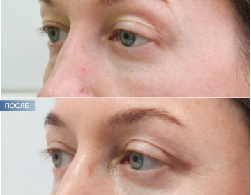 Блефаропластика