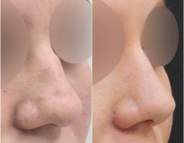 Ринопластика