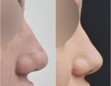 Ринопластика