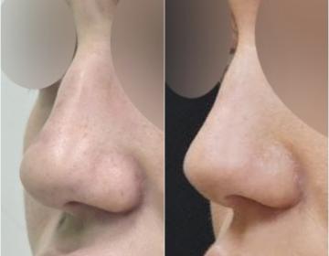 Ринопластика