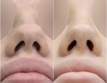 Ринопластика