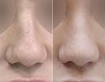 Ринопластика