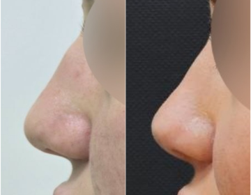 Ринопластика