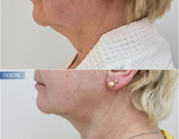 Пластика шеи и подбородка