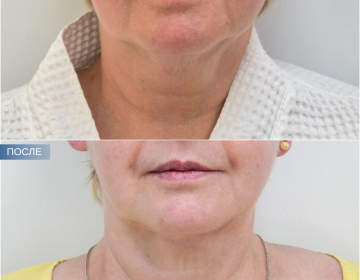 Пластика шеи и подбородка