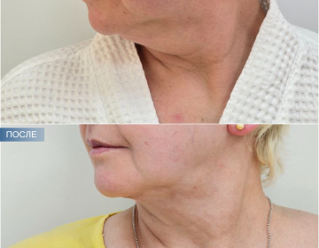 Пластика шеи и подбородка
