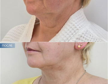 Пластика шеи и подбородка
