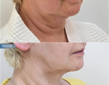 Пластика шеи и подбородка