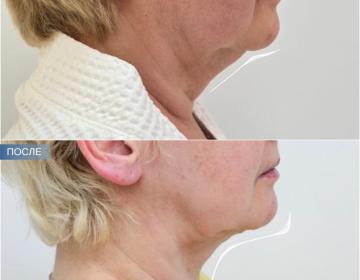 Пластика шеи и подбородка