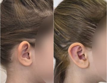 Пластика ушей