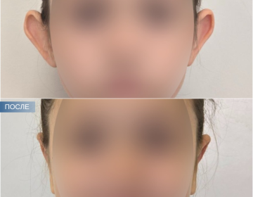 Отопластика