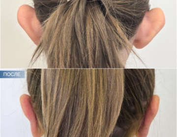 Отопластика