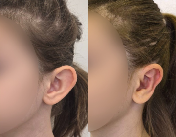 Пластика ушей