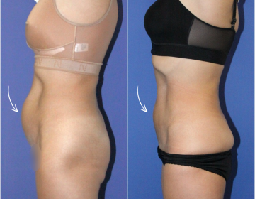 Липосакция