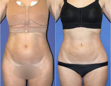 Липосакция