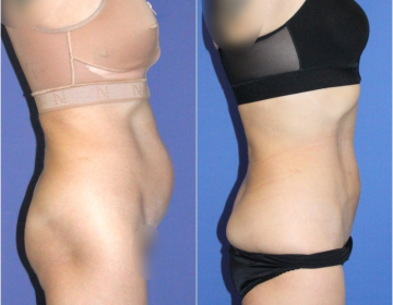 Липосакция