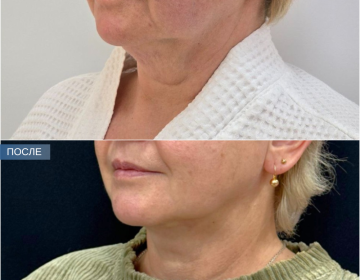 Пластика шеи и подбородка