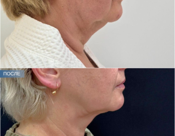 Пластика шеи и подбородка
