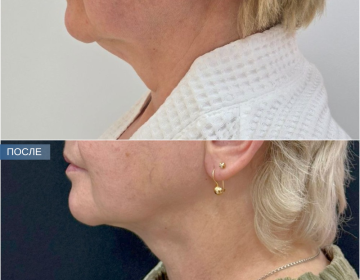 Пластика шеи и подбородка